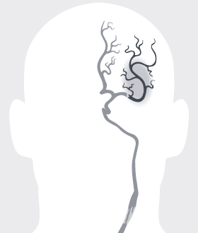 Accidente cerebrovascular isquémico