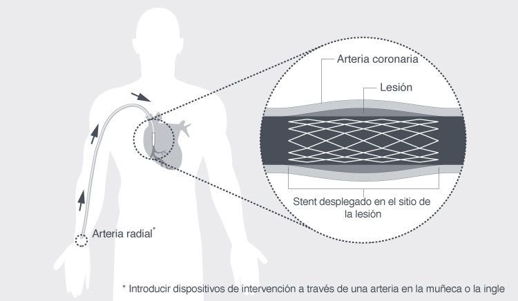 Terapia intervencionista vascular