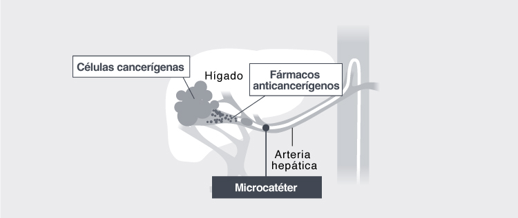 Oncología Intervencionista