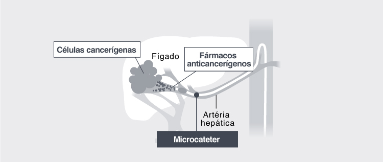 Oncologia Intervencionista