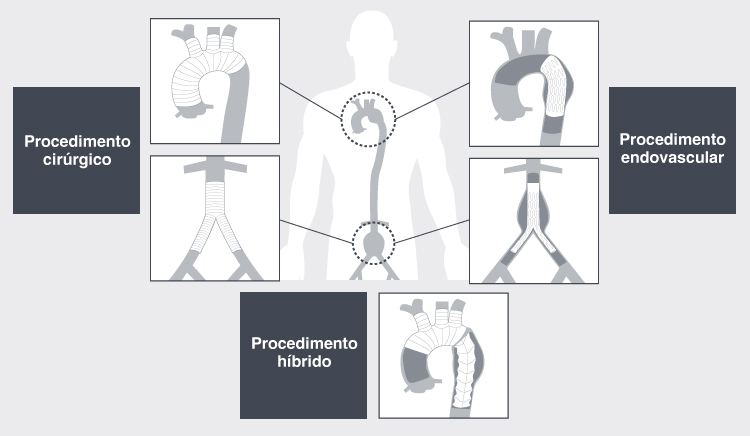 Tratamento de Doença Aórtica