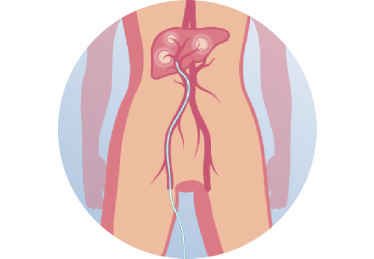 Figure 1. The microspheres are administered to the liver using a catheter which is placed in (distal branches of) the hepatic artery